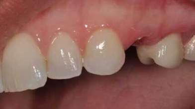 implantacziya-zubov-foto-do-i-posle 2 (1)