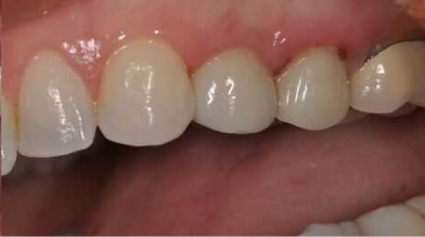 implantacziya-zubov-foto-do-i-posle 1 (1)